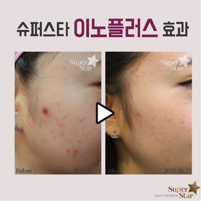 [구로피부과전문의]슈퍼스타피부과 피부과전문의 원장님에게 효과빠른 여드름 관리 이노플러스 시술 받으세요! 관련 이미지 4