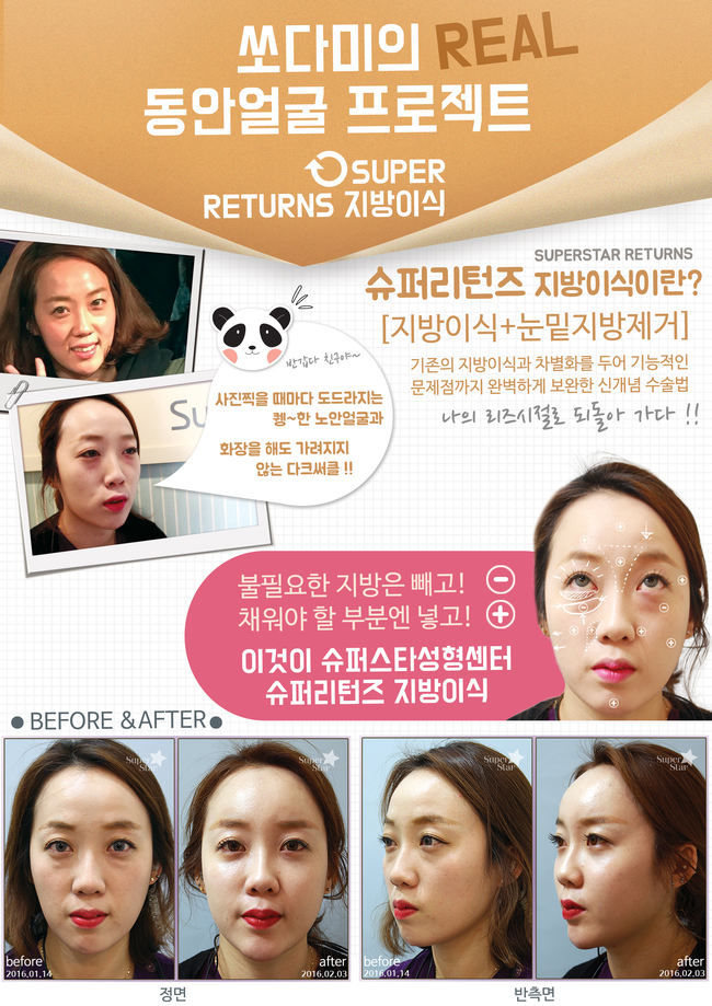 [구로성형]슈퍼스타 동안얼굴프로젝드~쏘다미의 리즈시절로 돌가는 슈퍼리턴즈지방이식 소개합니다! 관련 이미지 1