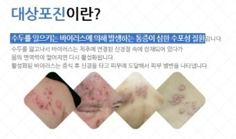 [구로피부과]구로디지털단지 슈퍼스타피부과차상희피부과전문의원장님~하이닥 대상포진관련 자문인터뷰! 관련 이미지 3