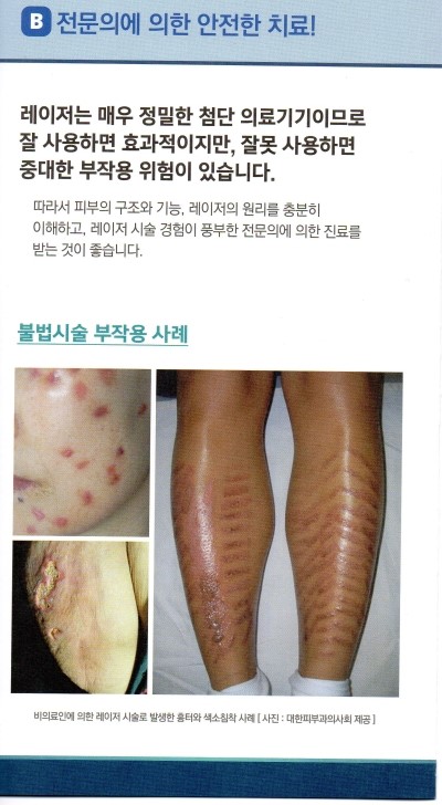 레이저 안전사용! 피부과 전문의를 꼭 확인하세요!! 관련 이미지 3