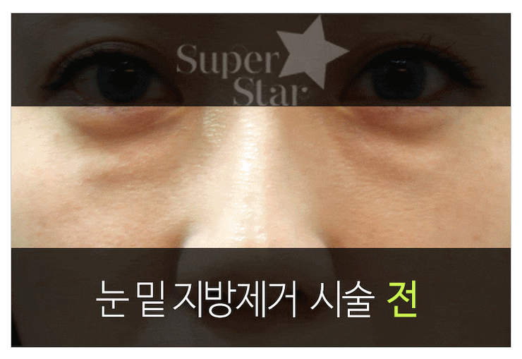 [구로성형]다크써클은 이제 NO!! 다크써클 없는 동안 얼굴 만들고 싶다면? 슈퍼스타 눈밑지방재배치술 주목하세요! 관련 이미지 3