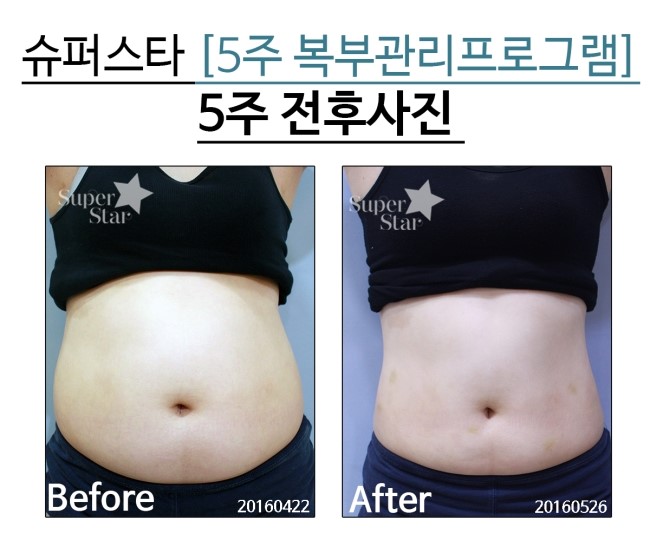 [구로비만클리닉]슈퍼스타 5주 복부관리 프로그램~마지막 시상식이 있었던 현장! 고고고~ 관련 이미지 4