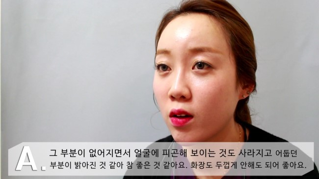 [구로성형]눈밑지방제거+얼굴지방이식=슈퍼리턴즈지방이식! 쏘다미의 수술후 한달! 관련 이미지 6