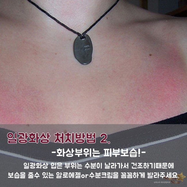 [구로피부과전문의] 슈퍼스타피부과가 알려주는 일광화상 처치방법~! 관련 이미지 4