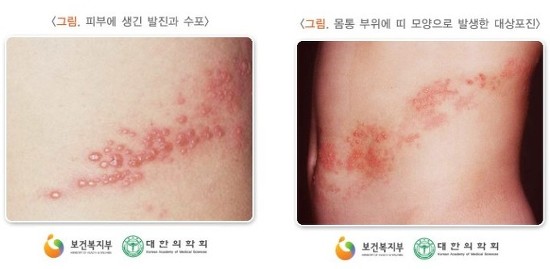 조스타박스 예방접종 맞고 대상포진 예방하세요~ 관련 이미지 1