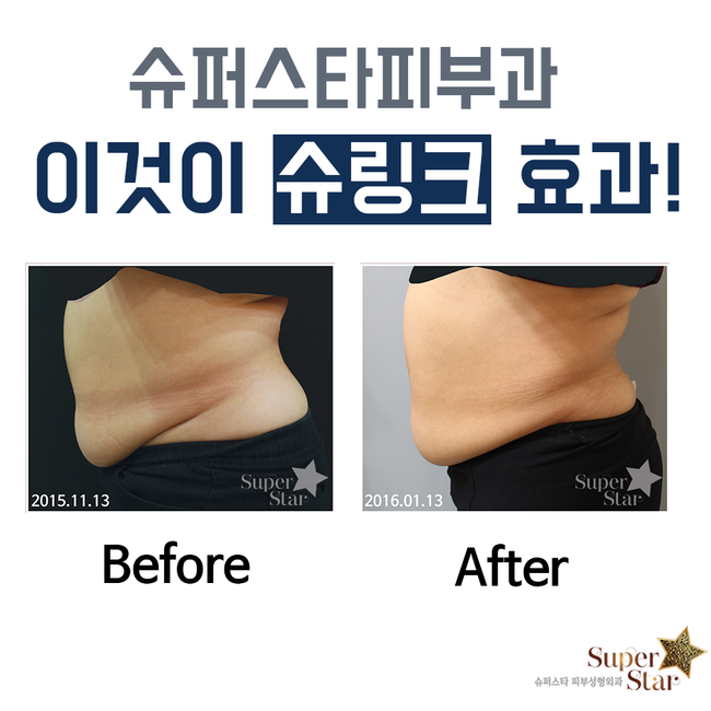 [구로피부과전문의]피부과전문의가 직접 시술하는 울트라포머3 슈링크! 슈퍼스타피부과에 도입되었답니다~ 관련 이미지 2