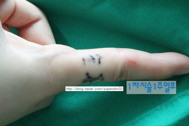 [구로문신제거]슈퍼스타피부과 손가락문신제거 3차시술 대.공.개!!~~~ 관련 이미지 1