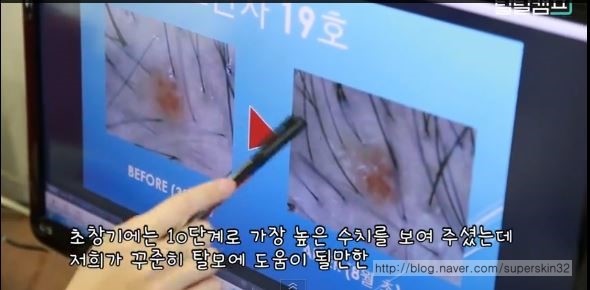 [구로탈모]구로피부과 슈퍼스타피부과 피부과전문의와 함께하는 탈탈캠프 19호님~ 6개월간의 기록입니다. 관련 이미지 10