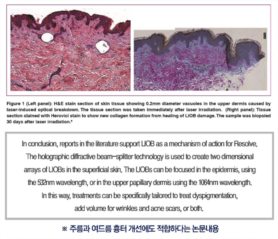구로디지털단지역피부과 피코플러스로 문신/색소/여드름흉터를 빠르게치료하세요 관련 이미지 8