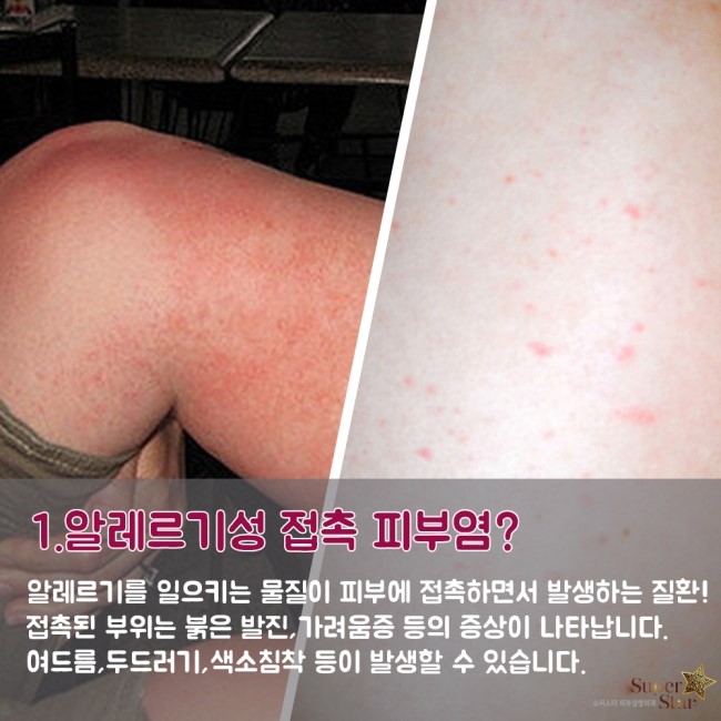 [구로피부과]슈퍼스타피부과가 알려주는 봄철 알레르기의 진실! 원인과 예방법 알려드려요~ 관련 이미지 2