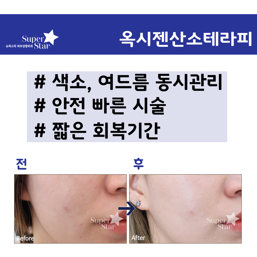 [구로피부과전문의]구로피부과전문의가 제안하는 슈퍼스타 재생프로그램~순수산소를 이용한 옥시젠산소테라피~ 관련 이미지 3