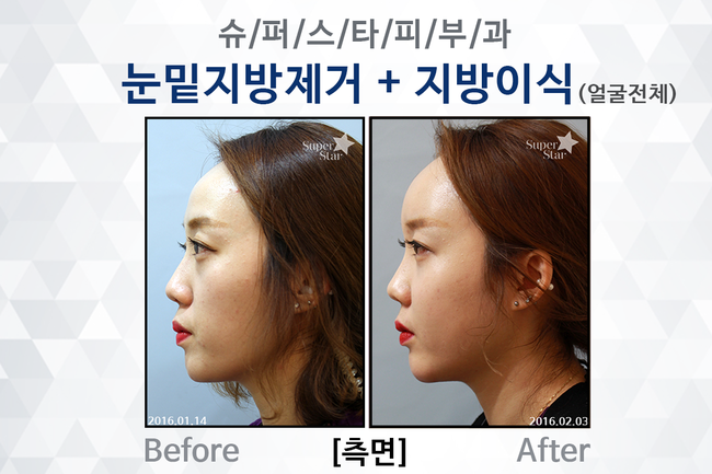 [구로성형]피곤하고 퀭한 노안의 적!다크써클과 꺼진얼굴~이제는 굿바이! 눈밑지방제거술과 얼굴지방이식으로 동안얼굴 완성! 관련 이미지 7