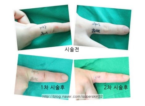[구로피부과전문의] 구로슈퍼스타피부과 문신제거~피부과전문의가 직접시술하는 안전하고 꼼꼼한 시술!! 관련 이미지 2