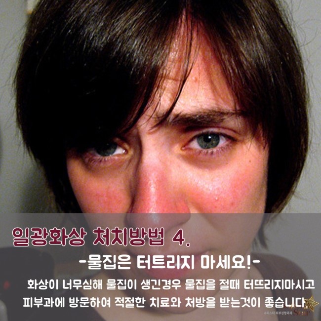 [구로피부과전문의] 슈퍼스타피부과가 알려주는 일광화상 처치방법~! 관련 이미지 6