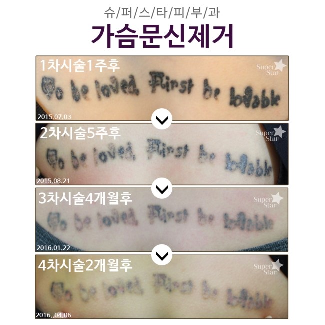 [구로피부과전문의]구로 슈퍼스타피부과 문신제거5차시술! 효과 대박~~피부과전문의에게 안전한 시술 받아보세요! 관련 이미지 2