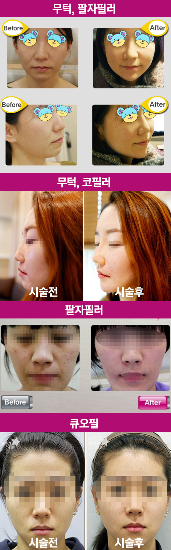 [구로피부과전문의]슈퍼스타피부과에서 알려주는 미용시술 이야기 - 필러 관련 이미지 11