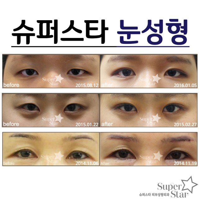 [대림성형외과 눈성형]구로에서 대림까지~멀리가지말고 가까운 슈퍼스타에서 아름다움을 찾으세요!! 관련 이미지 1