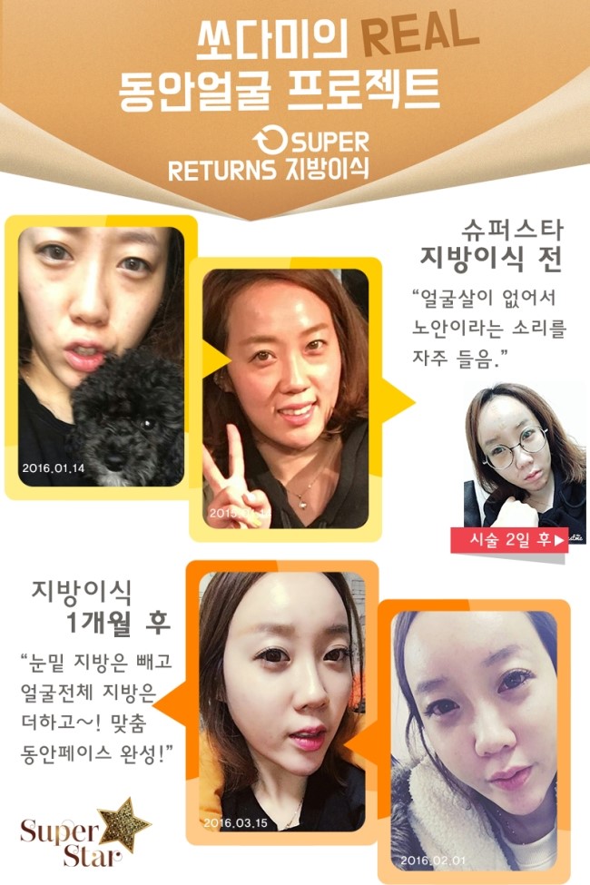 [대림지방이식]슈퍼스타 슈퍼리턴즈 지방이식~당신의 리즈시절을 되찾아드립니다★ 관련 이미지 1