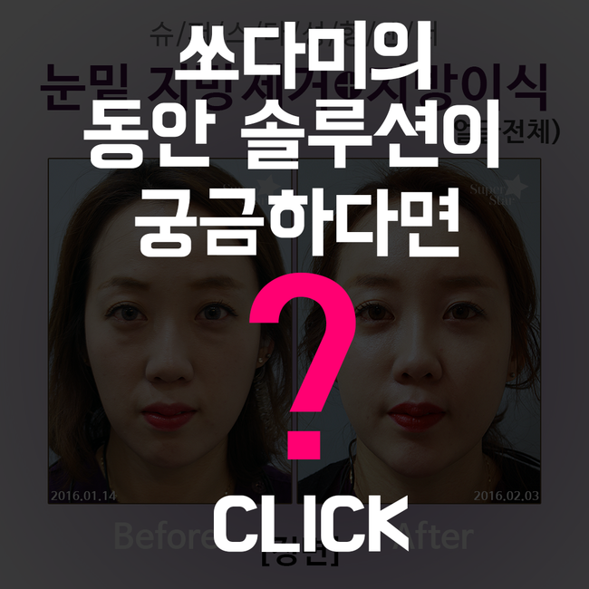 [구로눈성형]슈퍼스타 쏘다미의 동안얼굴 프로젝트~!!제 2편 뚜둔!! 수술 후 15일, 쏘다미의 변화된 이야기! 관련 이미지 5
