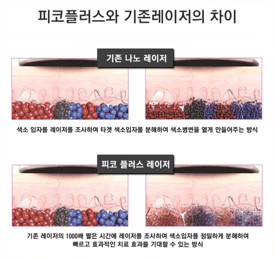 구로디지털단지역피부과 피코플러스로 문신/색소/여드름흉터를 빠르게치료하세요 관련 이미지 5