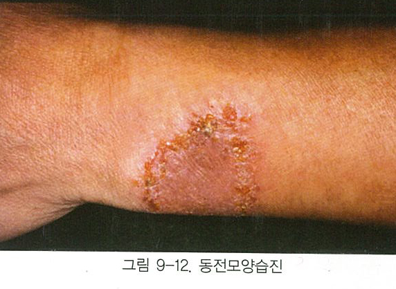[구로피부과전문의]슈퍼스타피부과에서 알려주는 피부질환 이야기 - 화폐상 습진 [동전모양습진] 관련 이미지 3