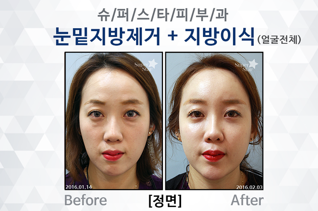 [구로성형]피곤하고 퀭한 노안의 적!다크써클과 꺼진얼굴~이제는 굿바이! 눈밑지방제거술과 얼굴지방이식으로 동안얼굴 완성! 관련 이미지 5