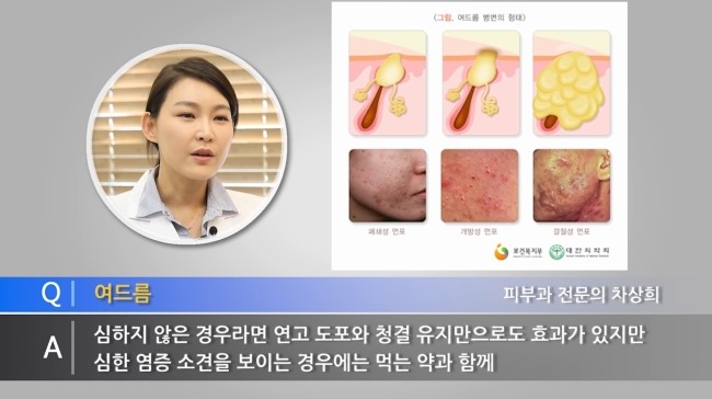 여드름 관리하는 방법 & 여드름 짜는 방법 관련 이미지 3