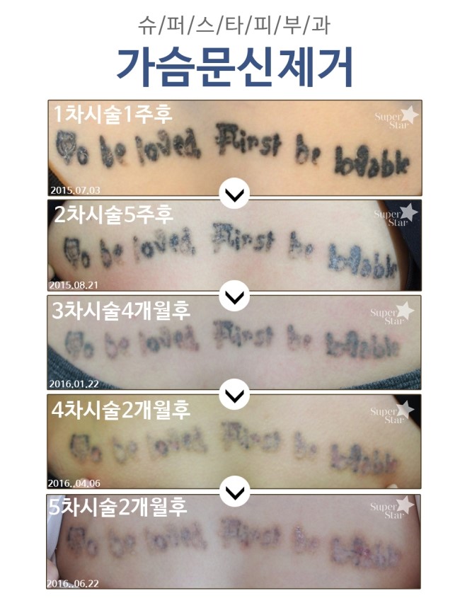 [구로피부과전문의]구로 슈퍼스타피부과 문신제거 2달 후 경과~ 멀리가지 마시고 구로 문신제거는 슈퍼스타피부과에서~ 관련 이미지 1