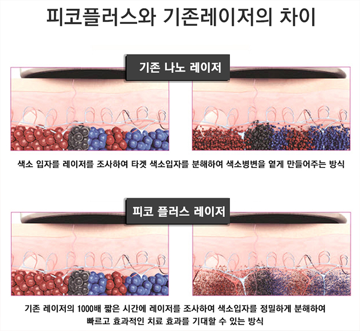 구로디지털단지역피부과 문신제거 정보드려요 관련 이미지 2