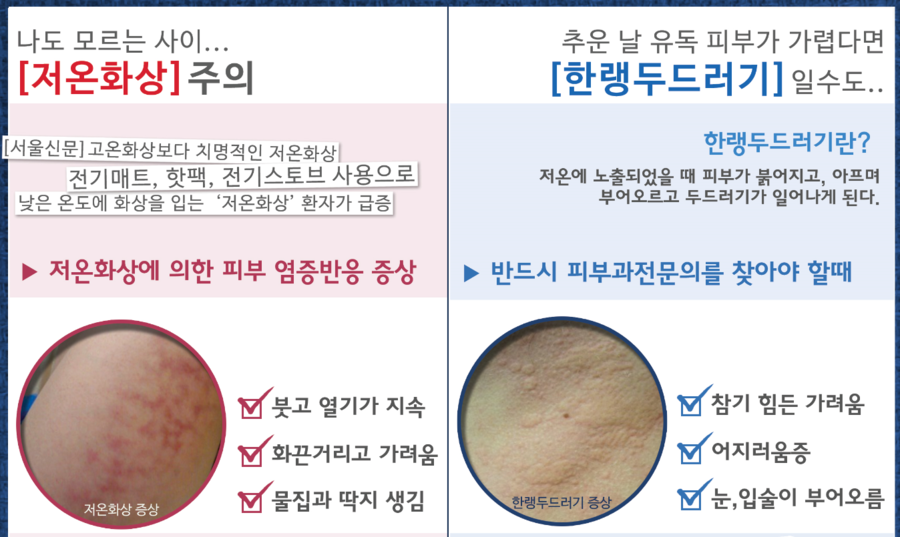 [구로피부과전문의]슈퍼스타피부과 피부과전문의가 제안합니다! 겨울철 피부의 적 저온화상, 한랭두드러기 조심하세요! 관련 이미지 2