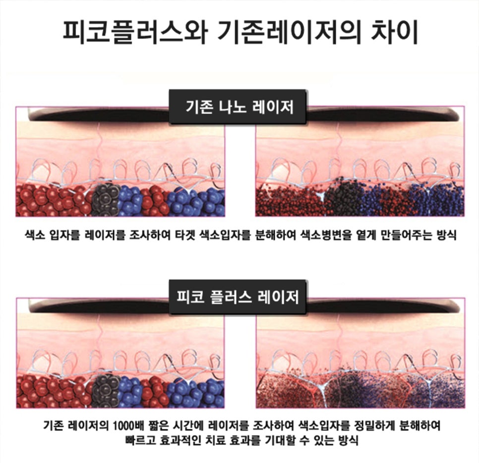 영등포/신도림피부과 문신제거는 피코플러스네요 관련 이미지 5