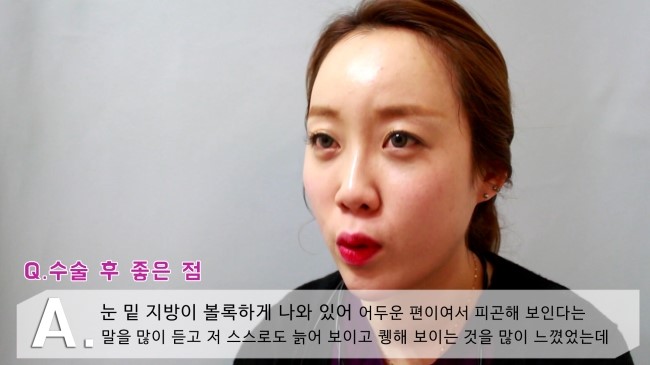 [구로성형]눈밑지방제거+얼굴지방이식=슈퍼리턴즈지방이식! 쏘다미의 수술후 한달! 관련 이미지 5