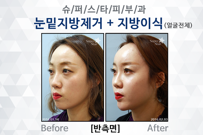 [구로성형]피곤하고 퀭한 노안의 적!다크써클과 꺼진얼굴~이제는 굿바이! 눈밑지방제거술과 얼굴지방이식으로 동안얼굴 완성! 관련 이미지 6