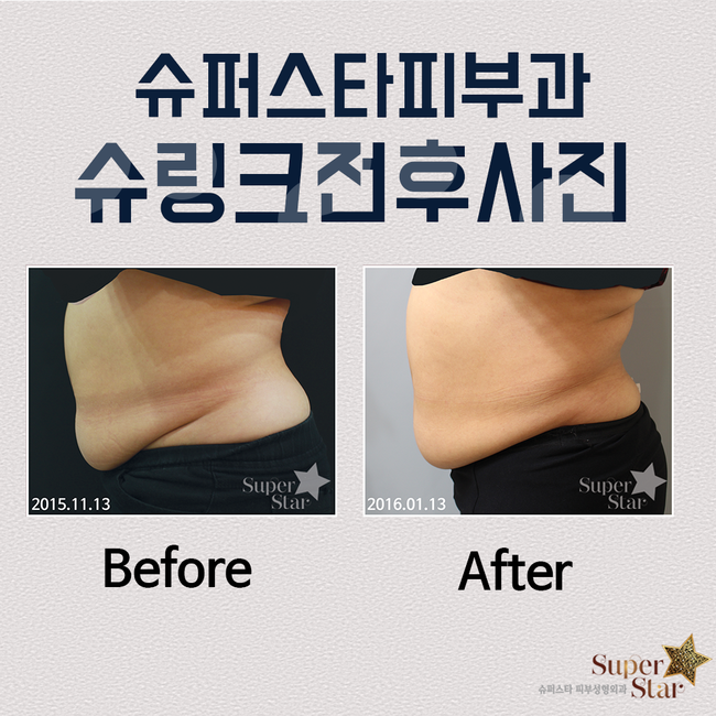 [구로피부과전문의]슈퍼스타피부과 초음파리프팅 슈링크리프팅이 도입되었답니다~ 주목하세용!! 관련 이미지 4