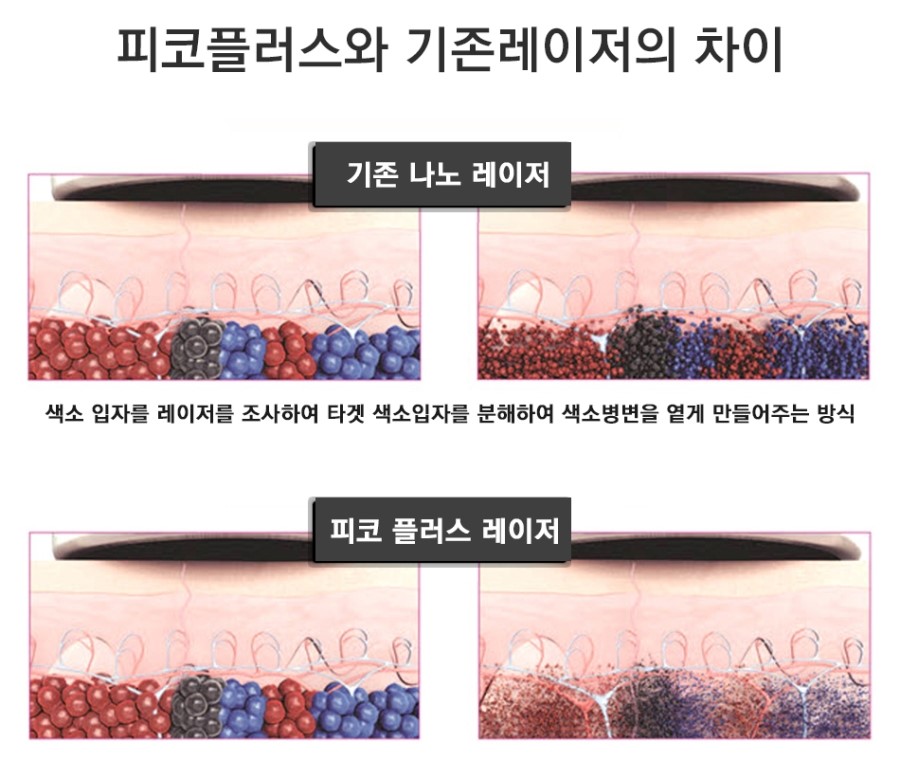 구로디지털단지피부과 문신제거 리얼스토리 관련 이미지 6