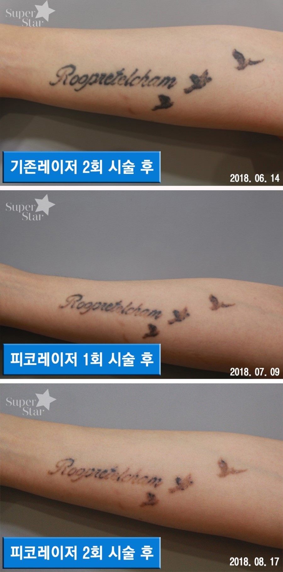 구로디지털단지피부과 피코플러스 문신제거 관련 이미지 2