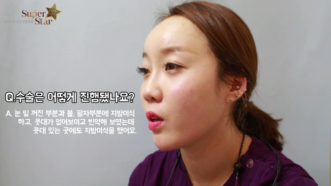 [구로눈성형]슈퍼스타 쏘다미의 동안얼굴 프로젝트~!!제 2편 뚜둔!! 수술 후 15일, 쏘다미의 변화된 이야기! 관련 이미지 3