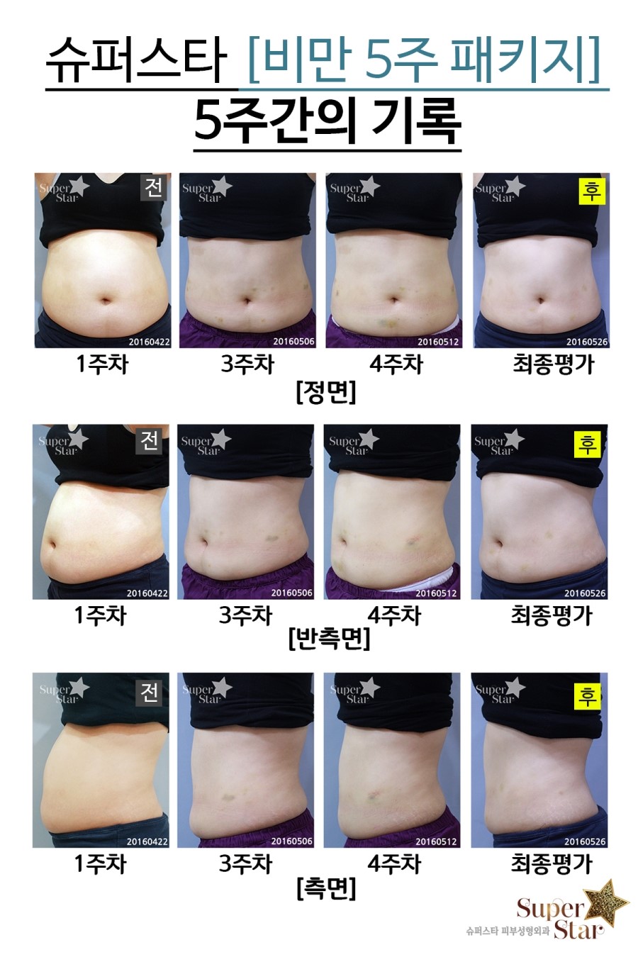 [구로비만클리닉] 비만패키지 최종이야기! 더욱 날씬해진 저희 쌤의 이야기가 듣고싶다면? 고고~ 관련 이미지 3