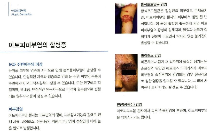 [구로피부과전문의]슈퍼스타피부과에서 알려주는 피부질환 이야기. 아토피 피부염-2 관련 이미지 5