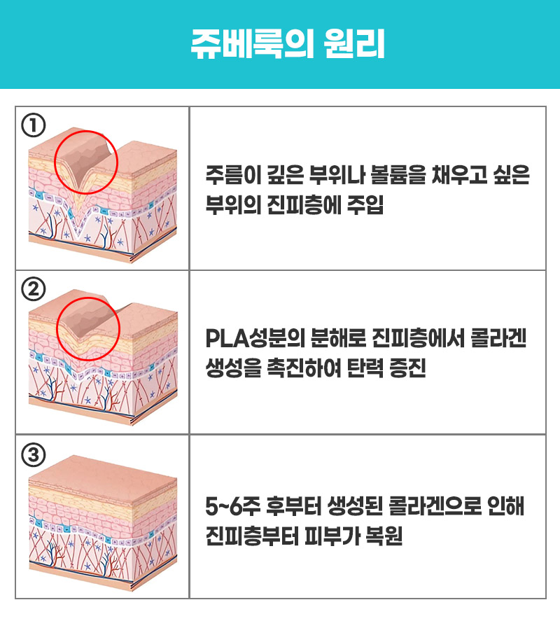 구로디지털단지역피부과 쥬베룩으로 재생과 볼륨 완성 관련 이미지 4