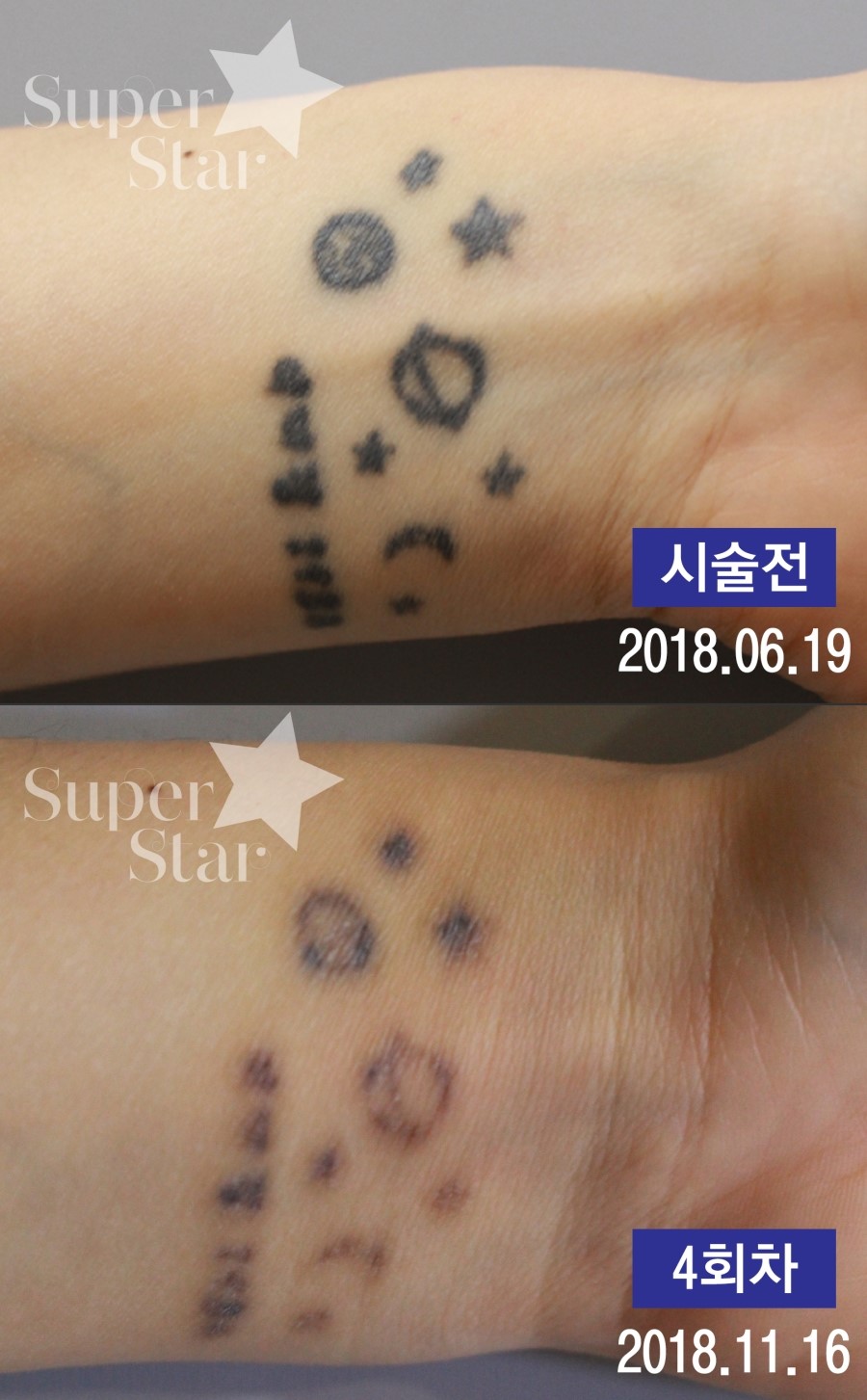 구로디지털단지역피부과 피코플러스로 문신/색소/여드름흉터를 빠르게치료하세요 관련 이미지 4