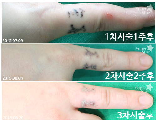 [구로피부과전문의]문신제거 확실한 효과가 있는 슈퍼스타피부과 피부과전문의에게 시술받으세요~ 관련 이미지 1