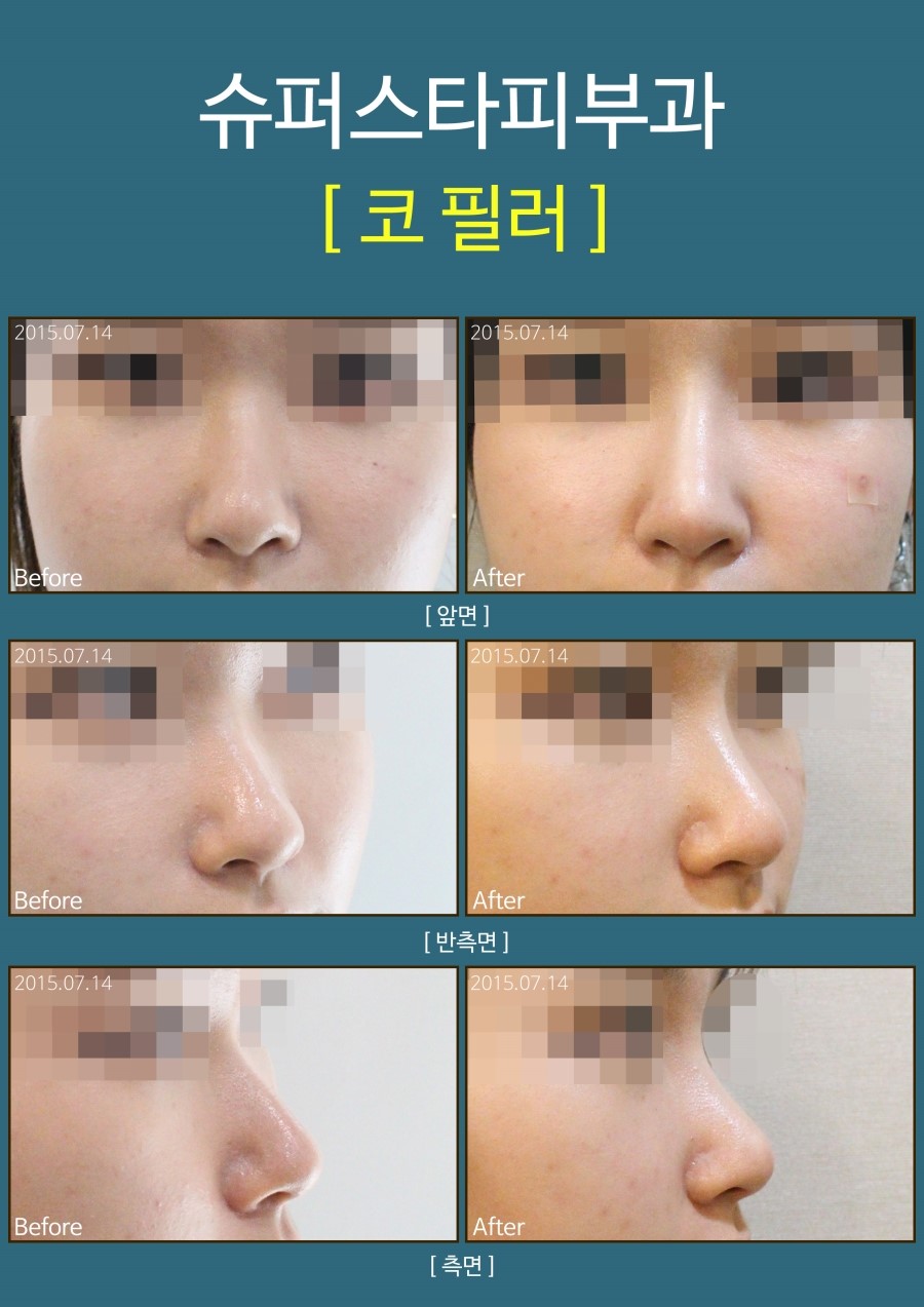 [구로피부과]슈퍼스타피부과에서 필러시술로 미인되자구용~~ 관련 이미지 1