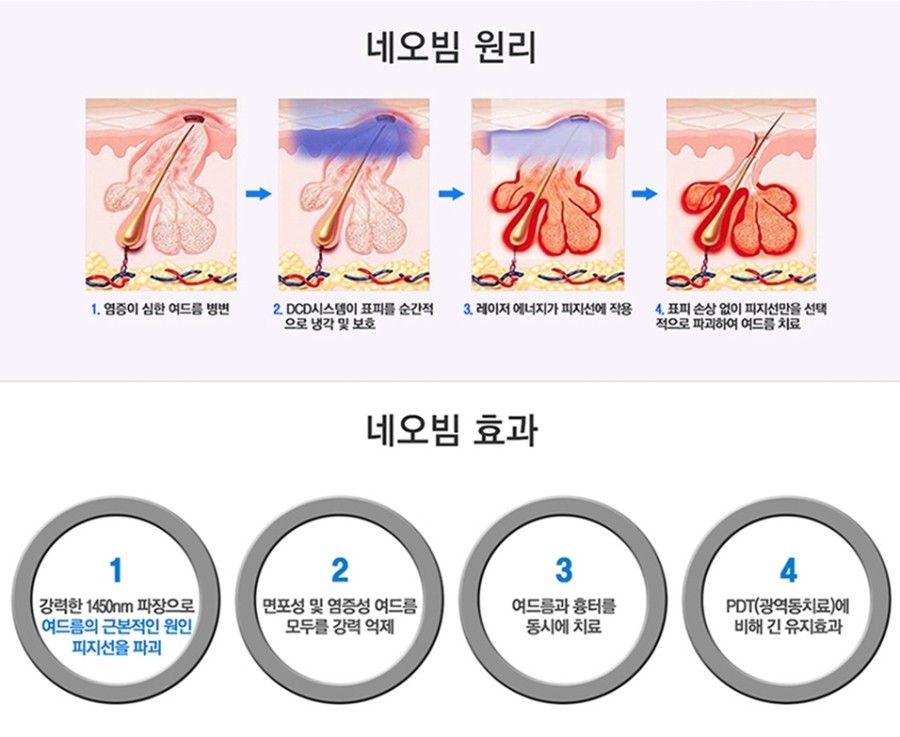 구로디지털단지역피부과 여드름치료방법 관련 이미지 5