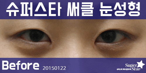 [구로성형]구로 눈성형잘하는 슈퍼스타! 써클눈성형으로 절개하지말고 쌍꺼풀 Get하세요~ 관련 이미지 2