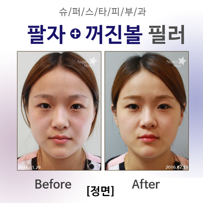 [구로피부과전문의] 전문의가 직접 시술하는 슈퍼스타 쁘띠필러! 간단하고 빠른 효과를 보고 싶으시다면 주목! 관련 이미지 3