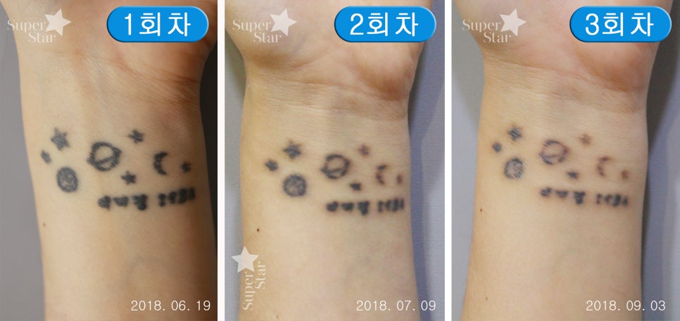 영등포/신도림피부과 문신제거는 피코플러스네요 관련 이미지 4