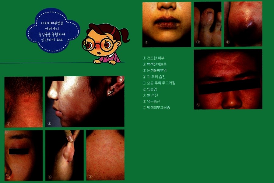 [구로피부과전문의]슈퍼스타피부과에서 알려주는 피부질환 이야기. 아토피 피부염-3 관련 이미지 3