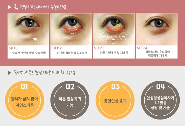 [구로성형]다크써클은 이제 NO!! 다크써클 없는 동안 얼굴 만들고 싶다면? 슈퍼스타 눈밑지방재배치술 주목하세요! 관련 이미지 2