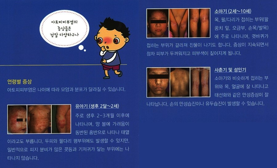 [구로피부과전문의]슈퍼스타피부과에서 알려주는 피부질환 이야기. 아토피 피부염-2 관련 이미지 3